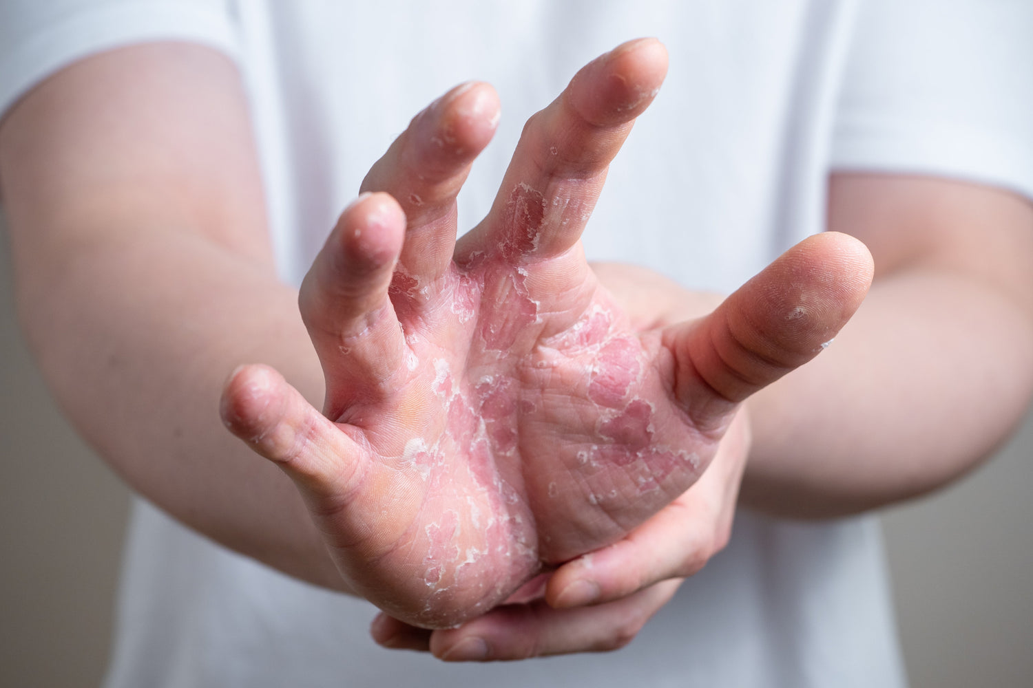 Cannabis: Neurodermitis behandeln mit Cannabinoiden?